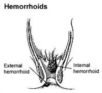 Hemorrhoids