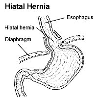 Hiatal-Hernia