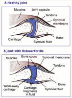 Osteoarthritis