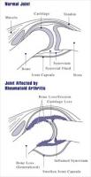 Rheumatoid-arthritis