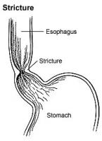 Stricture